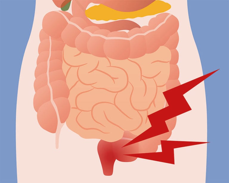 Haemorrhoids-inflammation